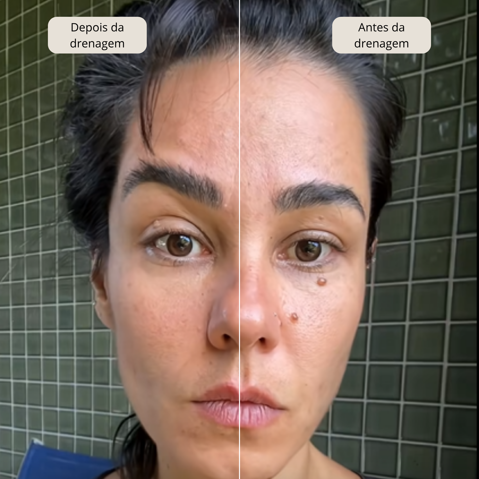 Koralift - Escova de Drenagem Facial