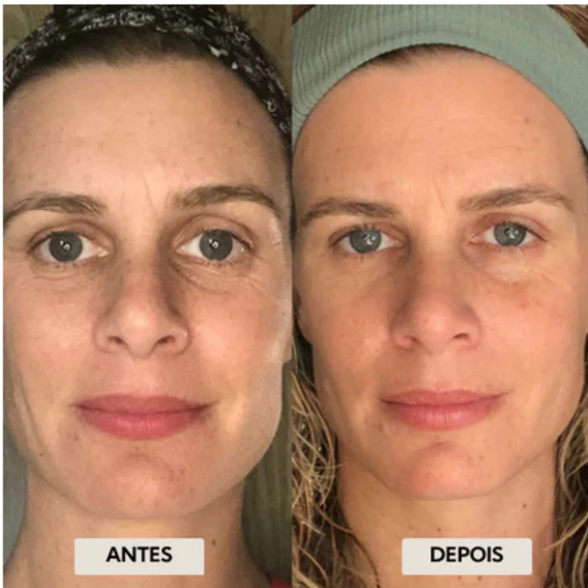 Koralift - Escova de Drenagem Facial